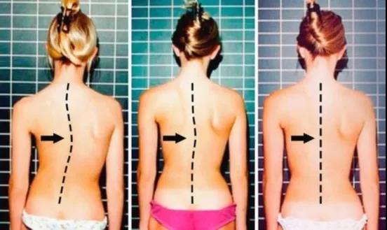 脊柱侧弯矫正视频教程完整,脊柱侧弯中医正骨矫正视频