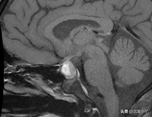 小丫说医｜一类影响全身的特殊脑瘤——“尽管罕见，但不能忽视”