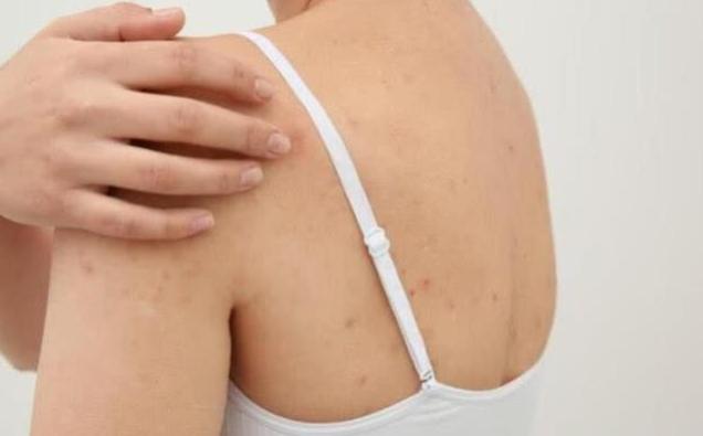 螨虫到处爬,大量螨虫