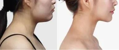 怎样练出下颚线最简单的动作,一招练出下颚线