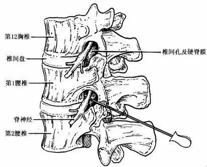 25岁得了腰椎间盘突出4年了,50岁腰椎间盘突出腰疼