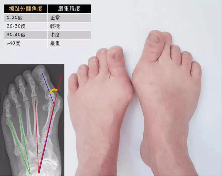 什么是拇趾外翻,拇趾外翻最好的锻炼方法