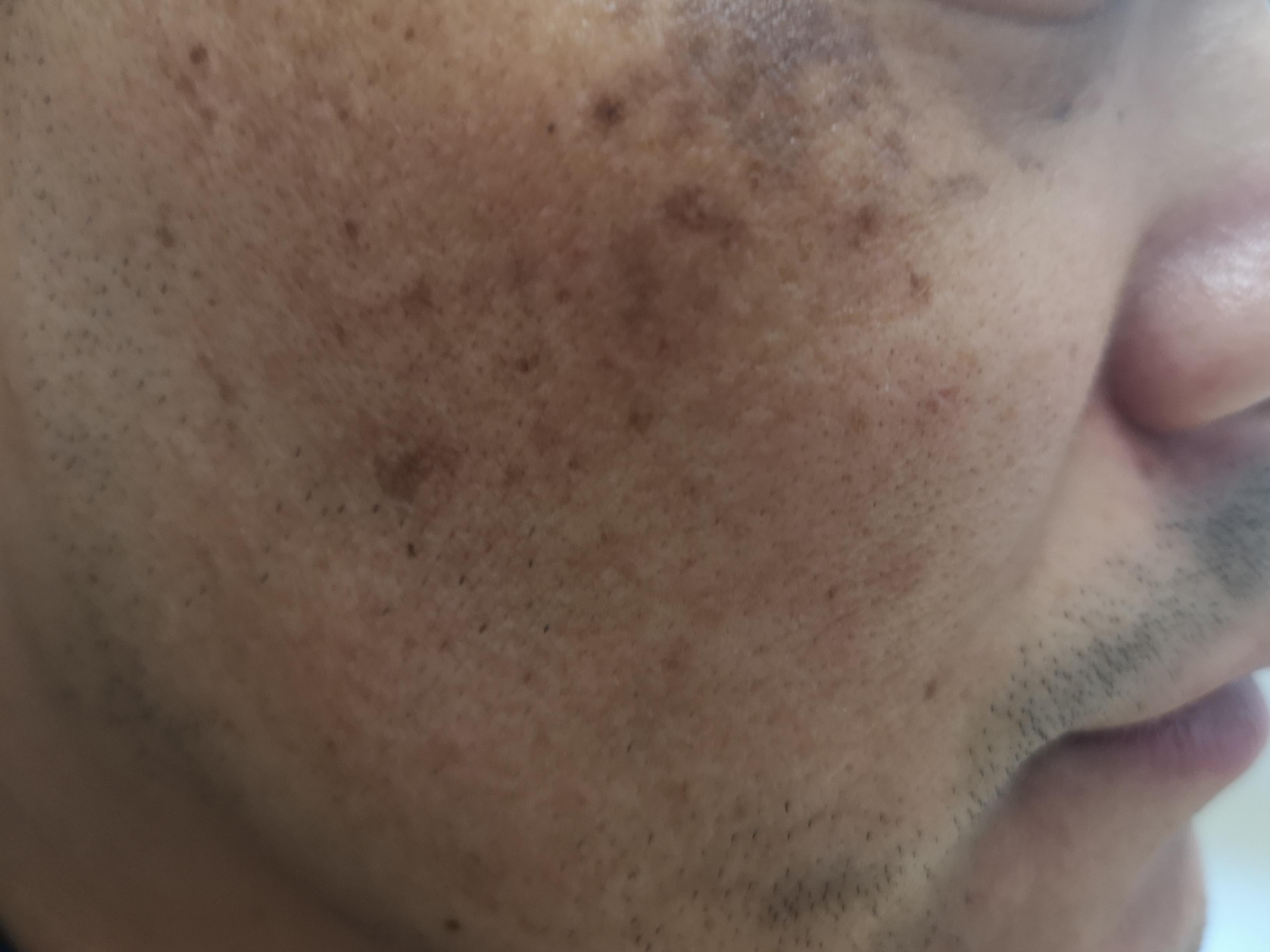 斑治疗越早效果越好,斑有没有办法治