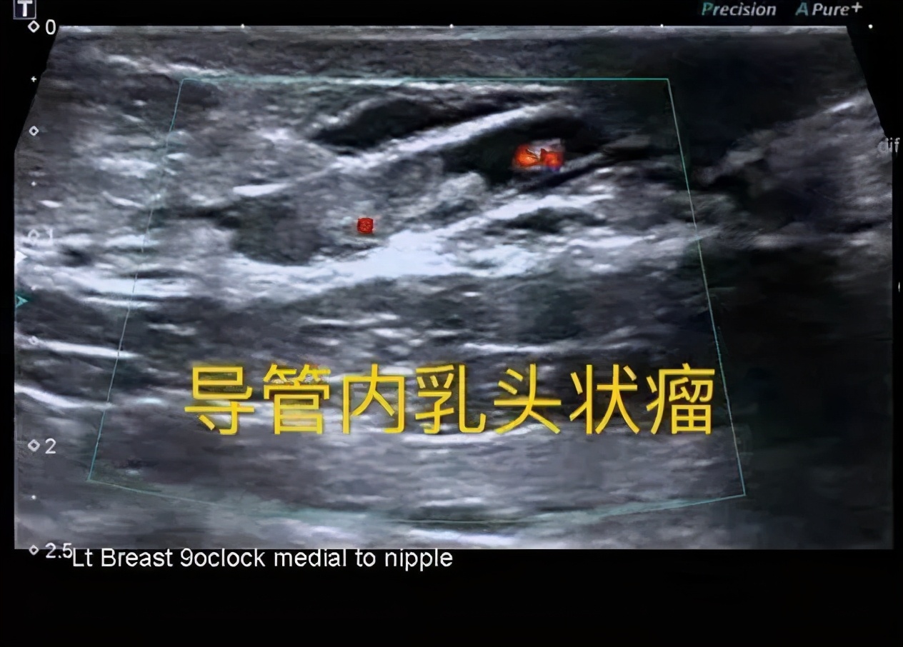 乳头“流水”,是乳腺癌吗?不可忽视的乳房信号