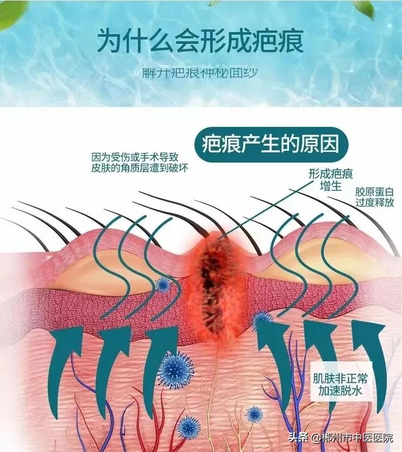 二氧化碳激光点阵掉痂后皮肤很干,二氧化碳点阵激光留下坑