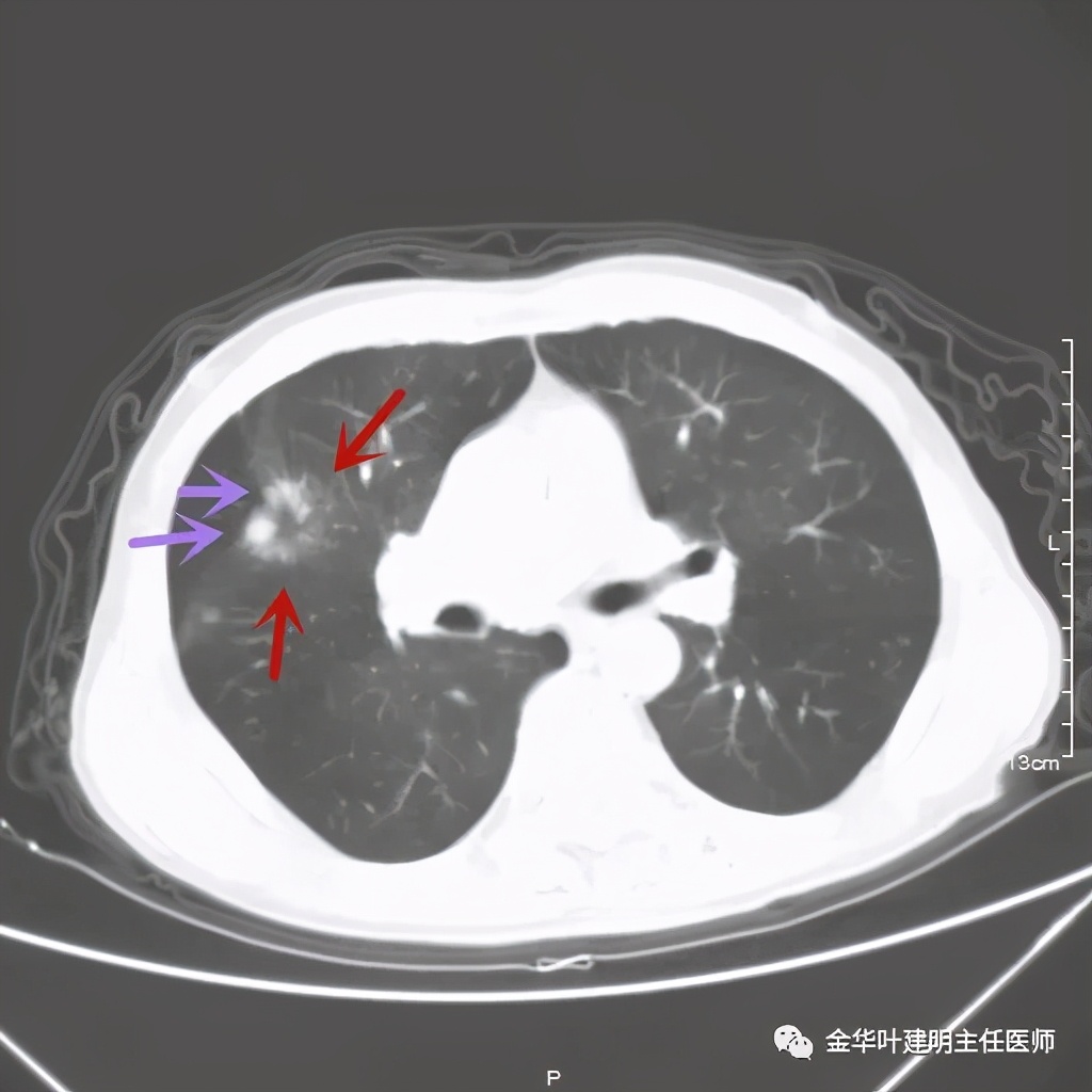 得了肺癌做肺部穿刺有影响吗,肺部穿刺可以确诊肺癌吗