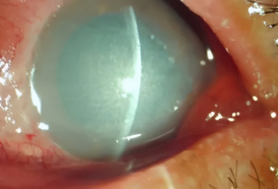 眼化学伤的图片,眼化学伤的急救处理