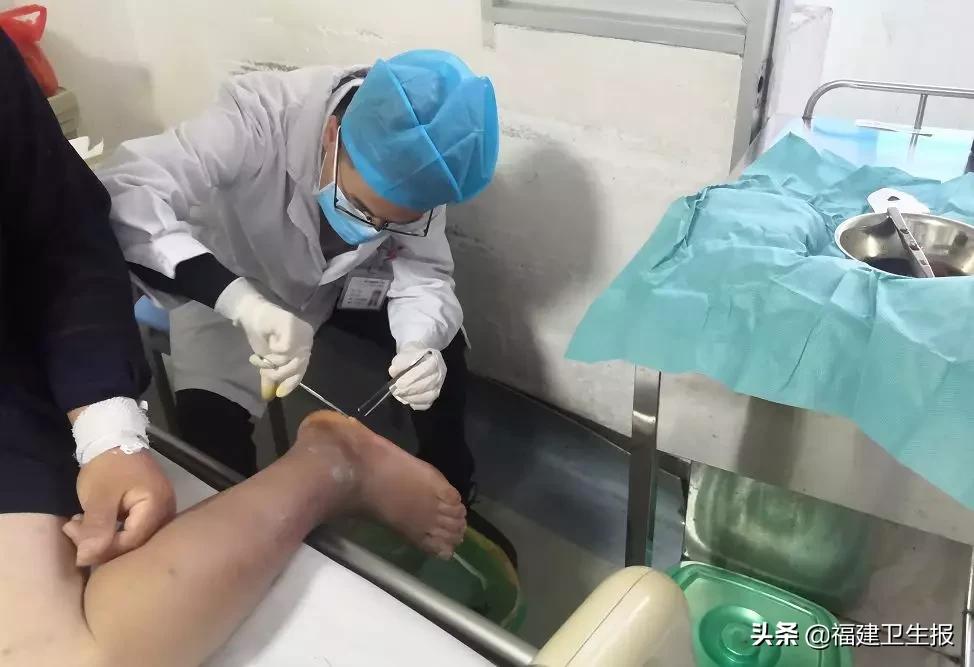 修脚感染致截肢,脚擦破皮会截肢吗