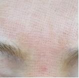 面部黑毛毛孔粗大,毛孔粗大面部暗沉