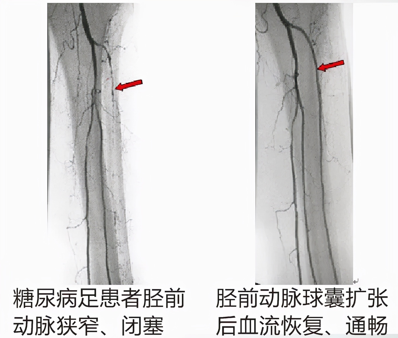 糖尿病足介入治疗与截肢的区别,糖尿病坏疽截肢还是做介入手术