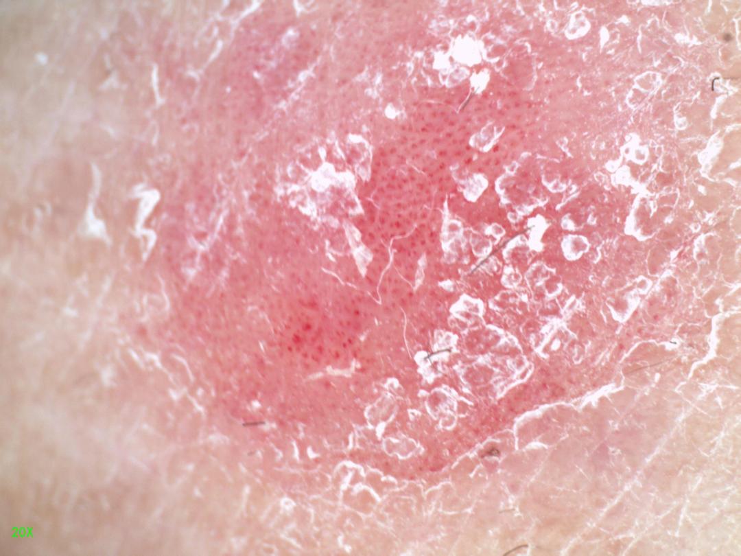 女儿得了银屑病怎么办,宝宝湿疹和银屑病区别