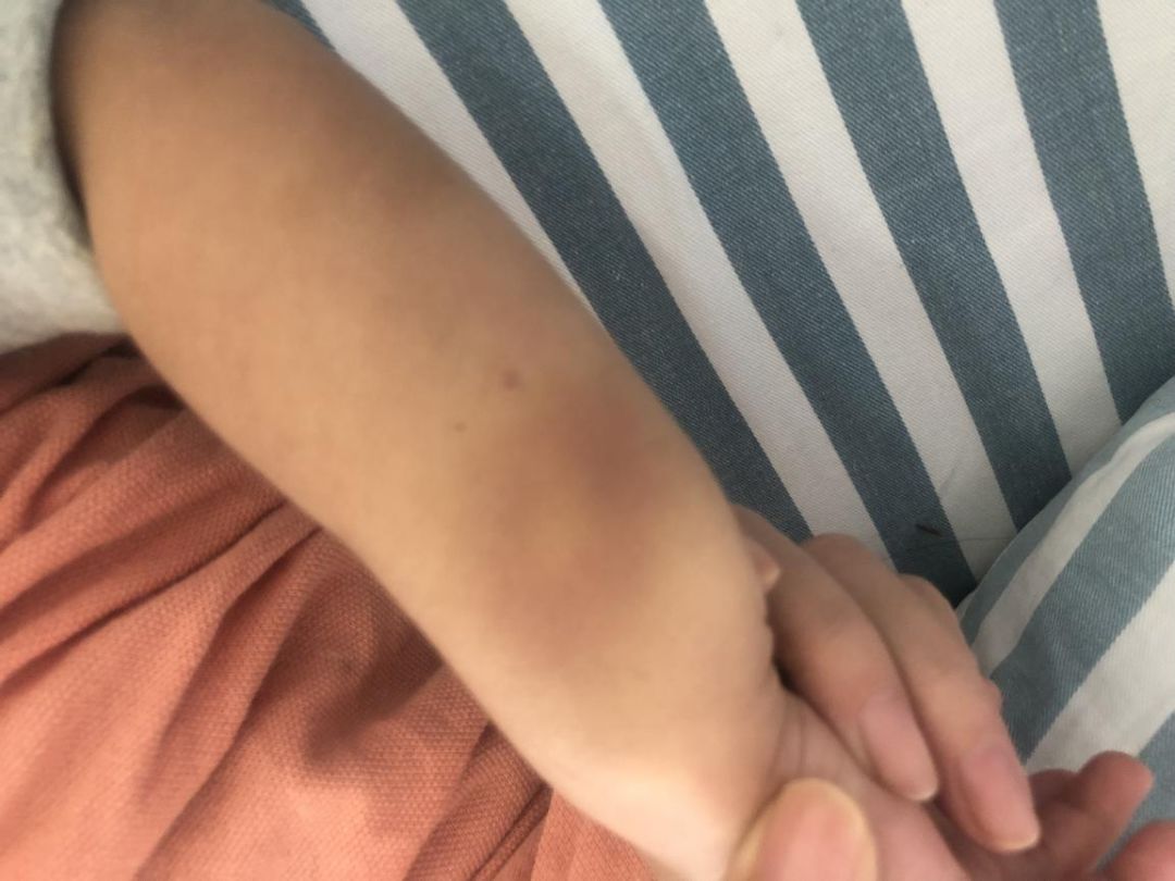 深圳2兄妹身上频现“离奇淤青”，医生：可能是吃出来的！咋回事