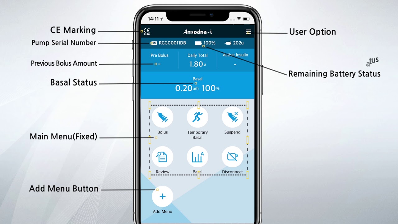 丹纳闭环胰岛素泵什么意思,丹纳胰岛素rs泵操作视频