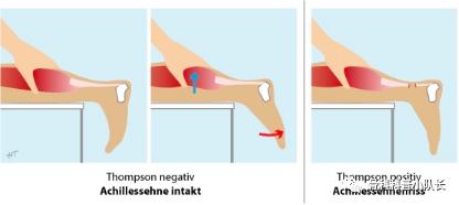 刚崴脚是要冷敷还是热敷,崴脚后24小时内是热敷还是冷敷