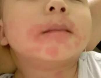 如何确定宝宝对奶粉过敏,奶粉蛋白质过敏会出现什么症状