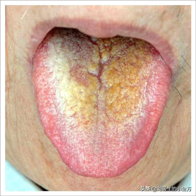 舌象图解大全中医舌诊,最全中医舌诊图谱来了