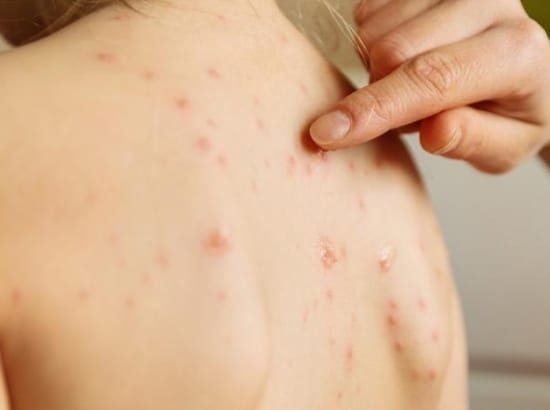 暗疮最好的消除方法 (暗疮印最佳治疗方法)