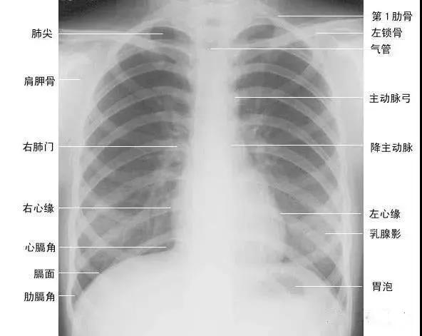 详细的胸部X线解剖，最基础最实用！