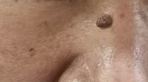 鼻梁上长了一个硬疙瘩是怎么回事,鼻梁上长了个黑色肉粒怎么回事