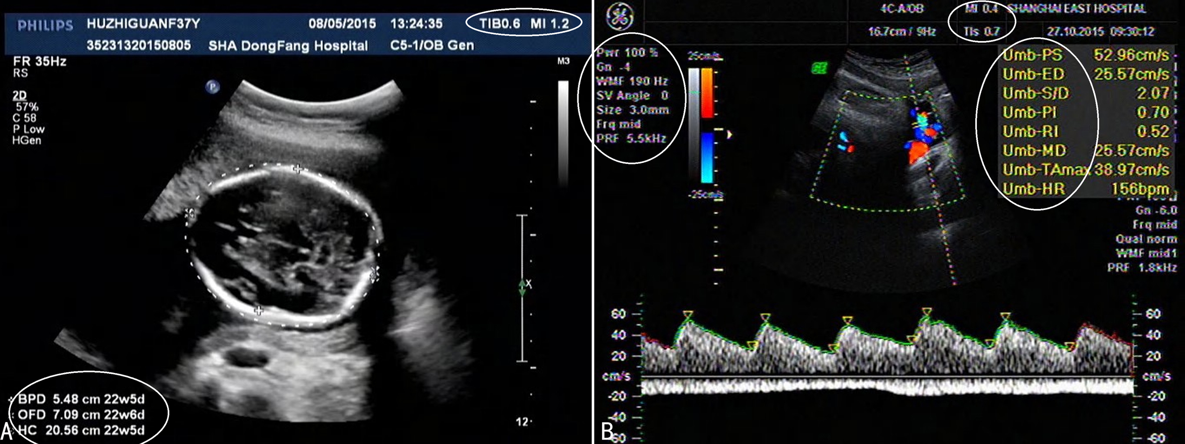 孕期彩色多普勒超声怎么看,多普勒超声检查孕期报告单怎么看