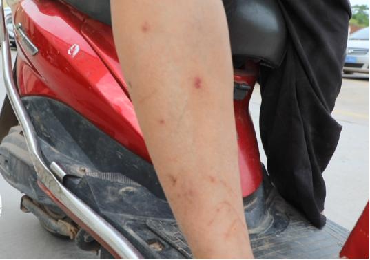 红火蚁入侵致多少人死,红火蚁伤人死亡新闻报道