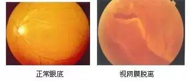 眼前一直有蚊子是什么病,眼前总有蚊子飞怎么治呀