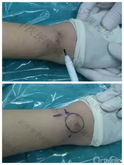 腱鞘囊肿除了手术还有什么办法,下颚有囊肿可以做穿刺手术