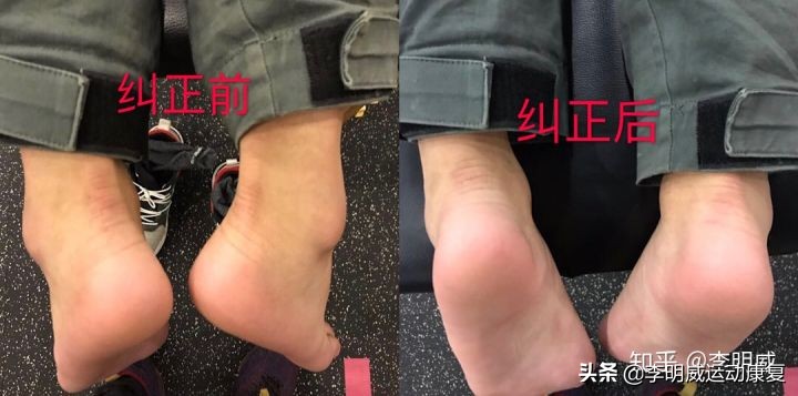 站斜板真的能纠正足内翻,矫正足内翻训练