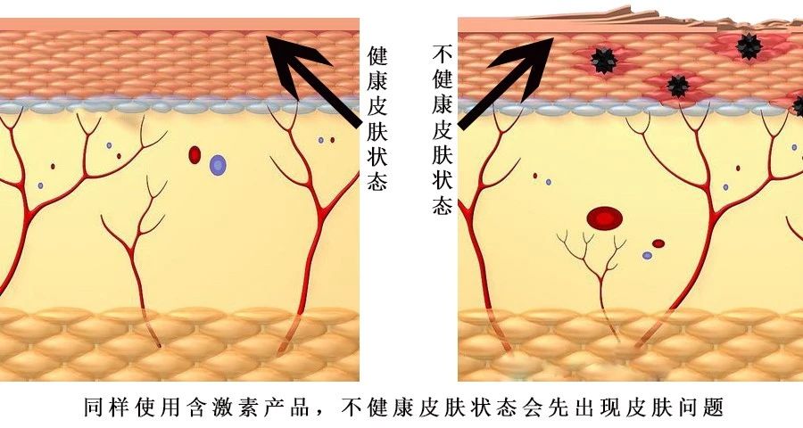 皮肤科激素依赖性皮炎,皮肤科名医激素依赖性皮炎