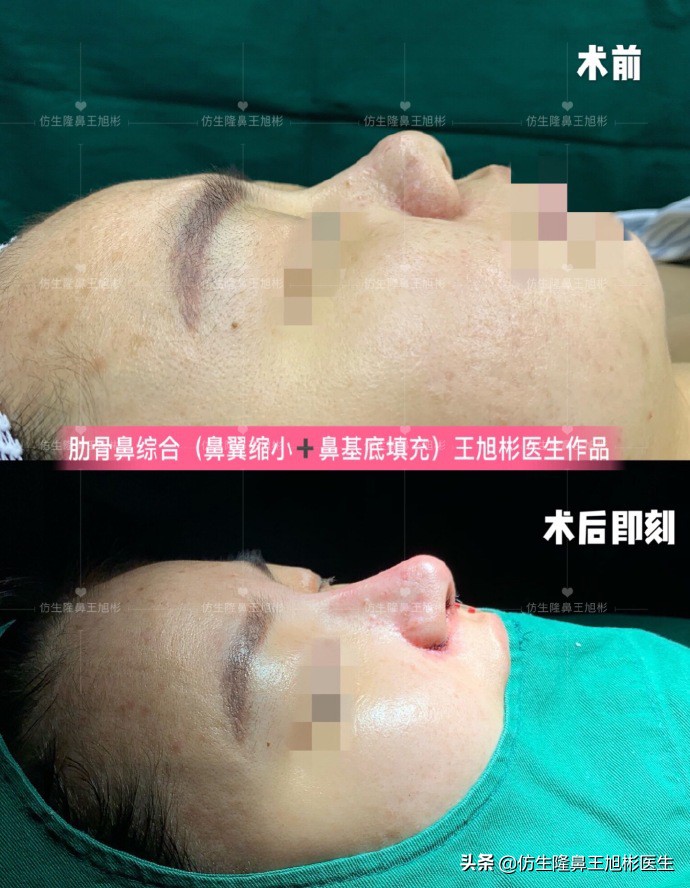隆鼻鼻头大是失败了吗,大鼻头隆鼻手术案例