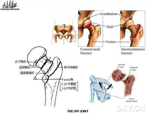 老人髋骨置换术后脱位如何处理,90岁老人摔断髋关节怎么办