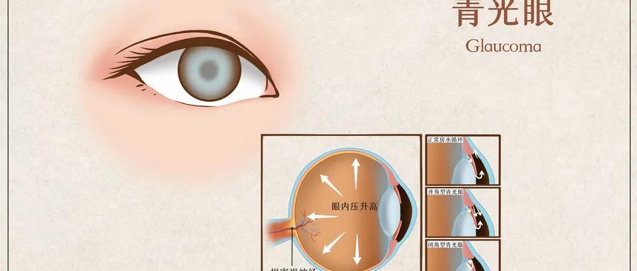 世界青光眼手术前沿,青光眼新技术攻克