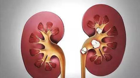 预防结石产生，从一杯碱性好水开始