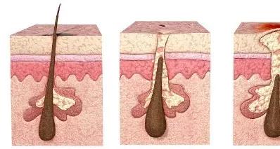 脱发部位长出细小毛,脱发长出细软绒毛