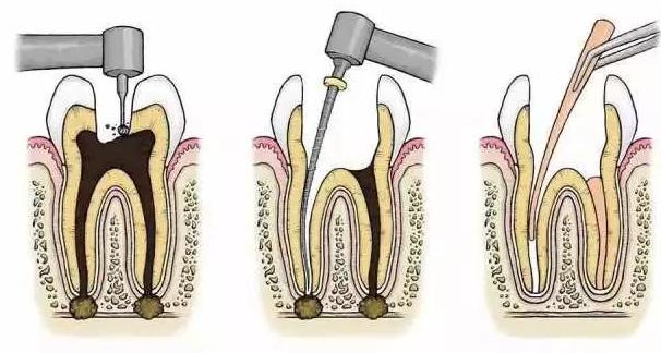 根管治疗步骤有哪些呢,根管治疗是针对什么情况