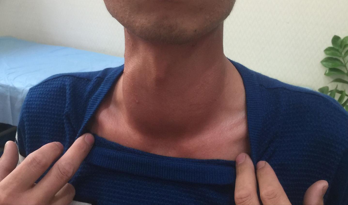 真实案例：甲状腺全切术后不仅留下“自杀式”切口，又出现感染