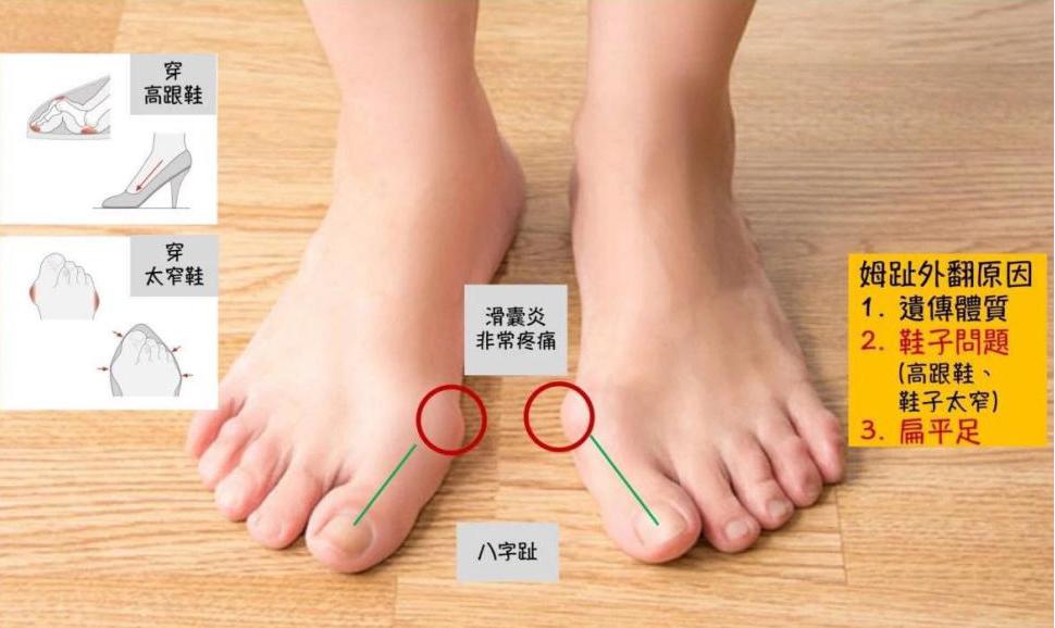 拇指外翻畸形的治疗方法,小孩脚拇趾外翻矫正方法