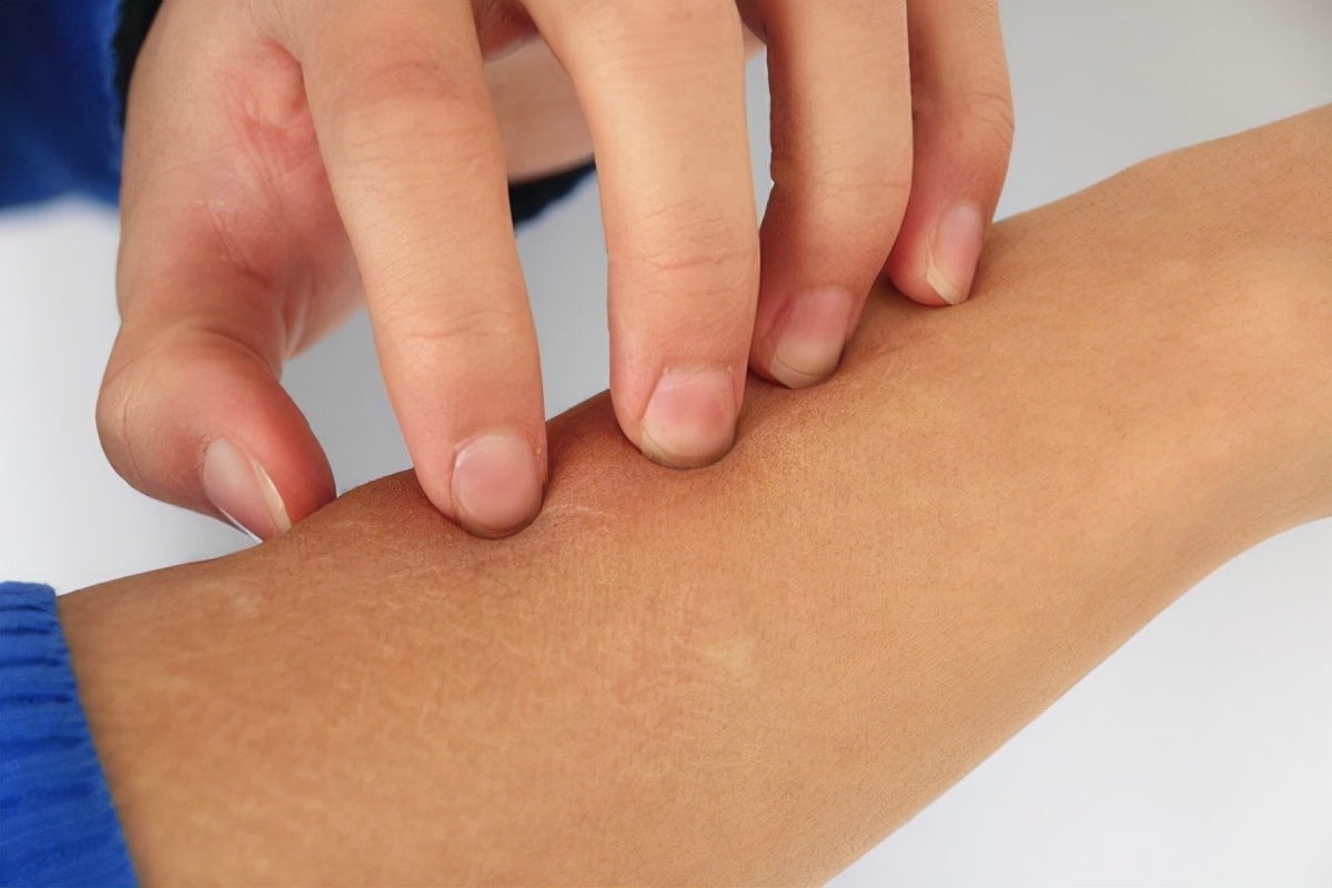 天气干燥皮屑多,天气干燥掉皮怎么办