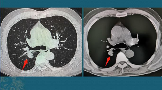 肺癌晚期和肝癌晚期哪个严重,肺癌开始到晚期需要多长时间