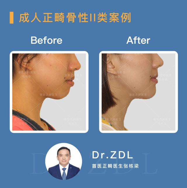 骨性龅牙做正畸还是正颌,骨性龅牙正颌手术前要正畸吗