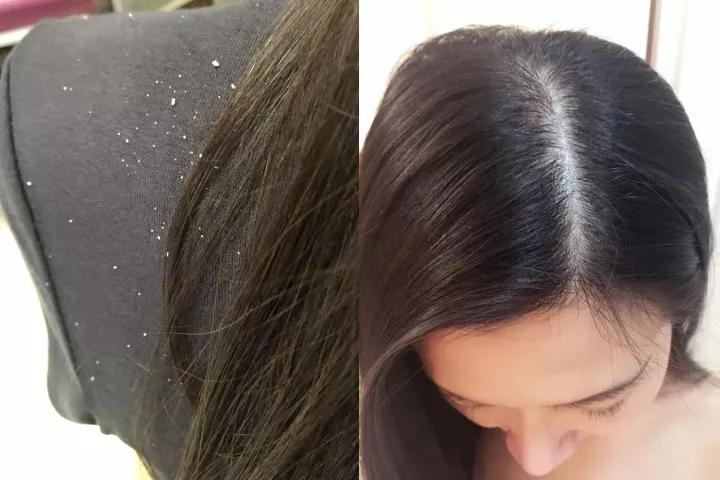 头屑满天飞用的洗发水,头屑一坨一坨的