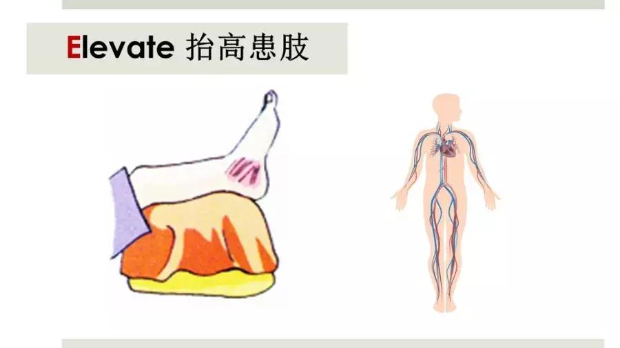 踝关节扭伤注意事项,踝关节扭伤的治疗原则