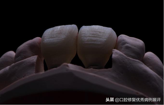 展评优秀病例赏析|Asc全瓷角度基台一体冠进行种植前牙美学修复
