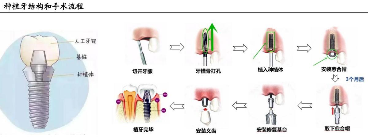 A股潜力赛道：千亿种植牙市场,附股）
