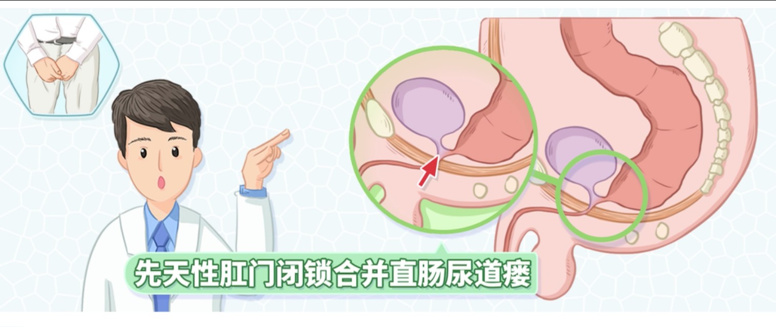膀胱直肠瘘是什么病,直肠尿道瘘是直肠癌的症状吗