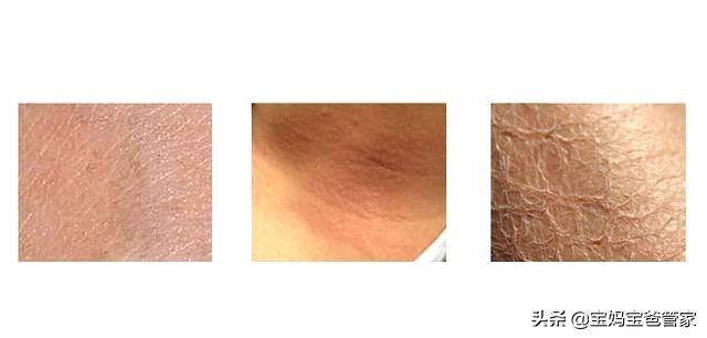 夏天脸上干燥起皮怎么办,如何缓解孕期皮肤干燥