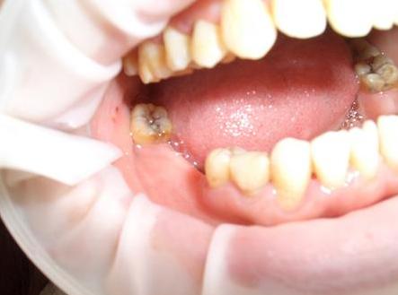 种植牙利与弊,种植牙有利也有弊如何权衡