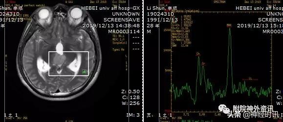 松果体占位怎样治疗,松果体区占位看什么科室