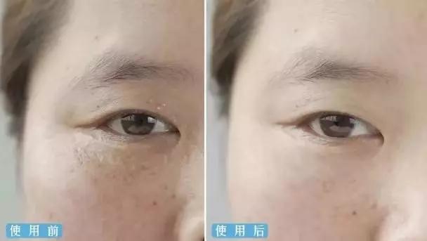 脂肪粒怎么用针挑出的,脂肪粒多久可以用针挑出来