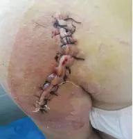 地塞米松新用途：轻松搞定医用胶粘剂相关性皮炎